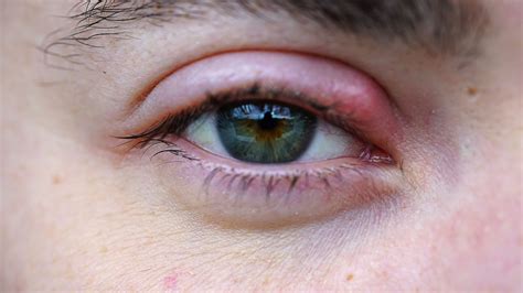  Preventing Recurrence: Tips to Help You Avoid Future Eye Stye Issues

