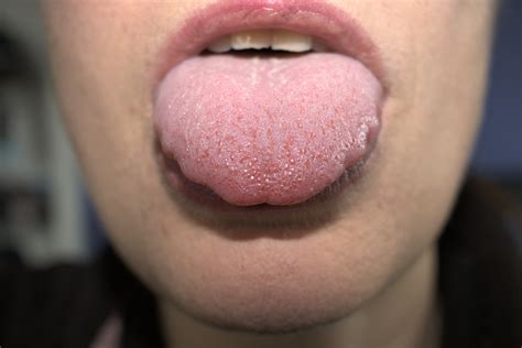 Common Causes of Tongue Swelling