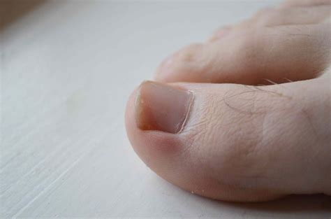Common Reasons for the Loss of Toenails in Dreams