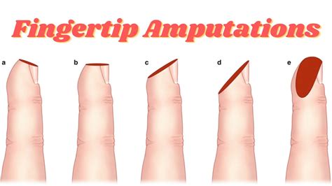 Cultural Beliefs and Superstitions Associated with Finger Amputations in Dreams