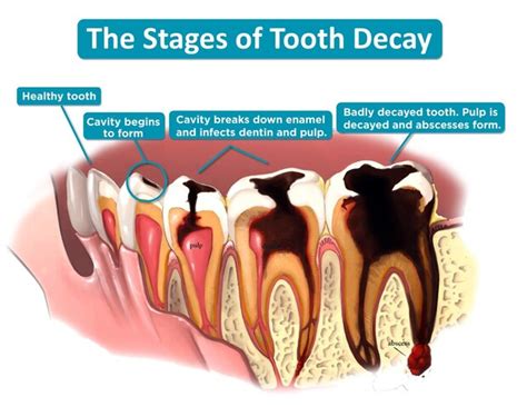 Cultural Perspectives on Dreams involving Decayed and Shattered Teeth