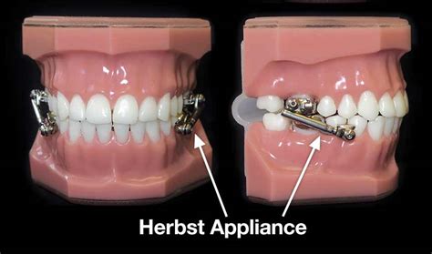 Deciphering the Meanings Behind Fractured Orthodontic Appliances: What Do They Represent?