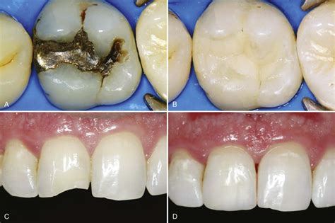 Deciphering the Symbolic Meaning of Dreams featuring Dental Restorations