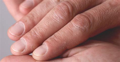 Dreams and Body Health: Investigating the Link between Absent Fingernails and Well-Being