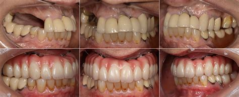 Examining the Psychological Factors behind Dreams of Replacing Teeth