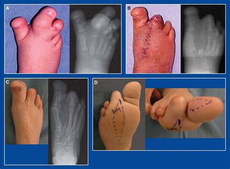 Exploring Cultural and Symbolic References to Toe Malformations