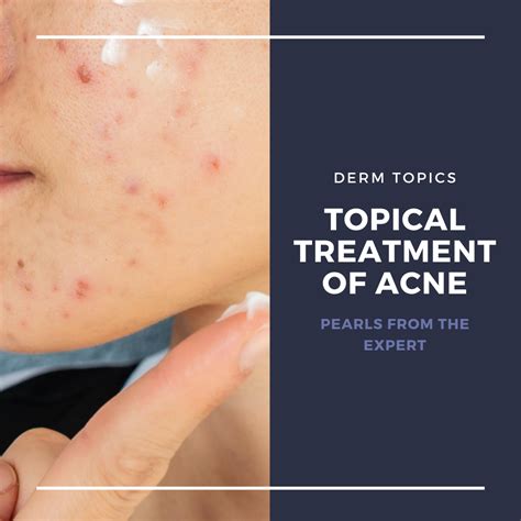 Exploring Effective Topical Treatments for Acne: