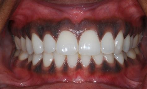 Exploring Treatment Options: Addressing the Concerns of Darkened Gum Pigmentation