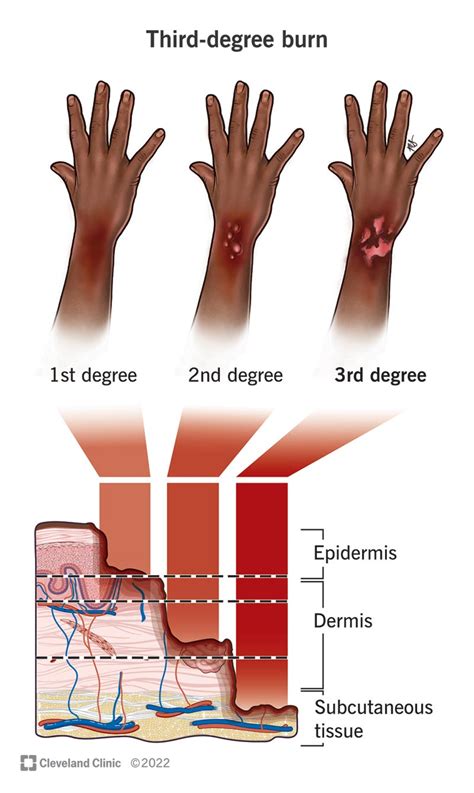 Exploring Various Types of Burns in Dream Imagery