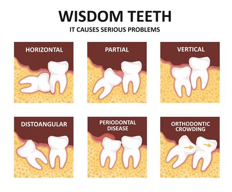 Exploring the Fascination with Extracting Wisdom Teeth: Essential Information to Unravel