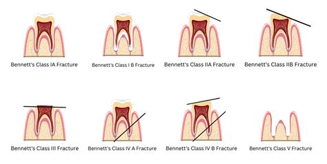 Exploring the Potential Physical and Emotional Triggers Associated with Dreams of Tooth Fracture