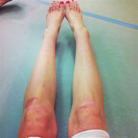 Exploring the Potential for Healing and Transformation in Dreams Featuring Bruised Legs