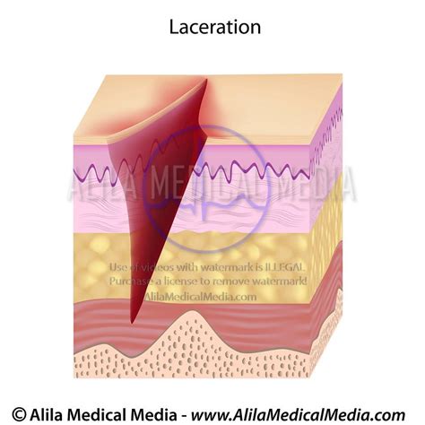 Exploring the Significance of Personal Relationships in Dreams about Skin Laceration