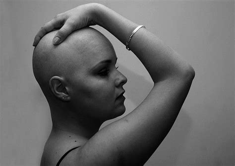 Exploring the Symbolic Significance of Alopecia in Dreams