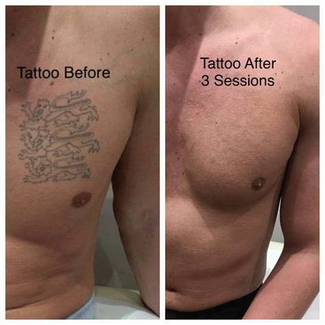 Exploring the Worth of Tattoo Removal Procedures: Weighing Pain and Cost