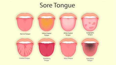 Identifying the Signs of Tongue Inflammation