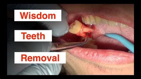 Insider Advice for a Successful Extraction of Wisdom Teeth