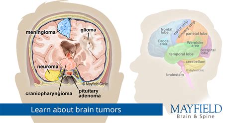 Interpreting Dream Symbols: Brain Tumors and Health Concerns