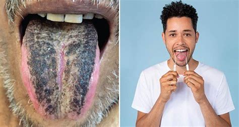Linking Hairy Tongue to Poor Oral Hygiene