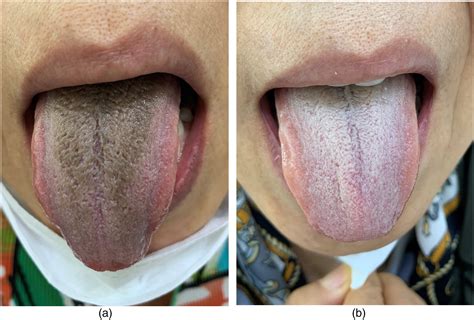Medical Conditions Associated with Hairy Tongue