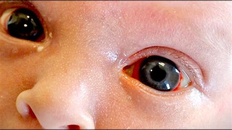 Nightmare or Warning? Untangling the Myths Surrounding Baby Bleeding Eyes