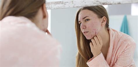 Possible causes of recurring dreams about the presence of acne