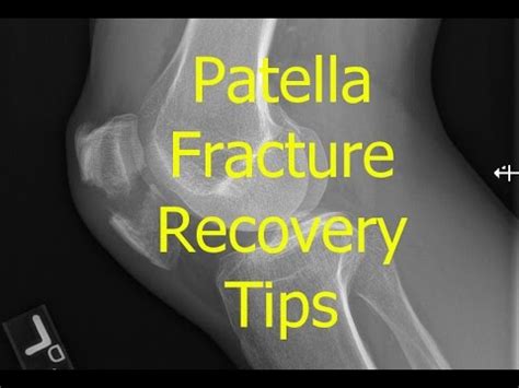 Practical Tips: What to Do If You Continuously Dream About a Fractured Patella