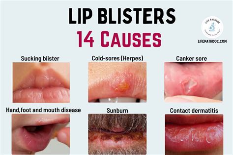 Psychological Interpretation: Decoding the Message behind Lip Blisters in Your Dreams