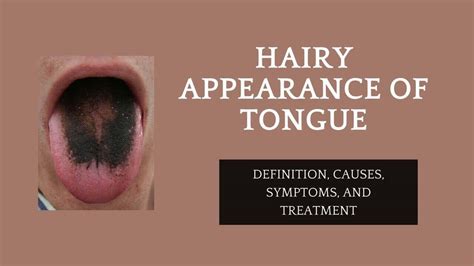 Seeking Professional Guidance: Options for Treating Hairy Tongue