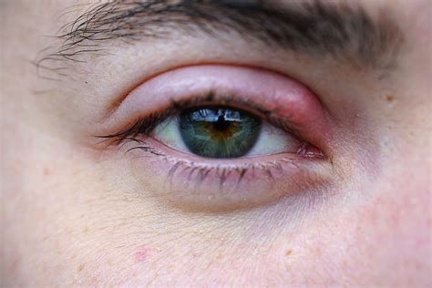 Telltale Signs: Recognizing the Symptoms of an Eye Stye