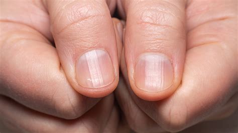 The Emotional Impact: Understanding the Psychological Effects of Dreams about Missing Fingernails