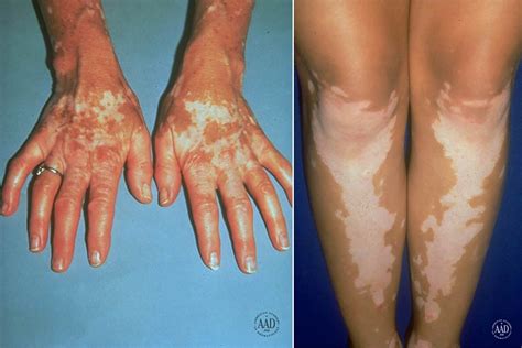 The Enigma Behind Pale Spots on the Epidermis