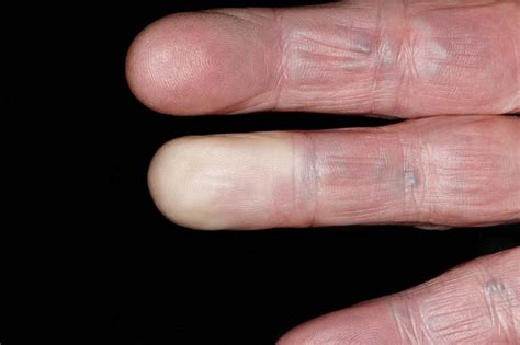 The Enigmatic Phenomenon of Bloodied Fingertips