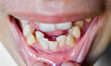 The Enigmatic Phenomenon of Misaligned Teeth in Dreams