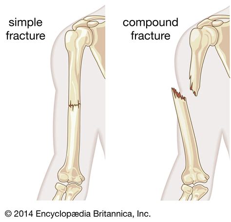 The Fractured Limb: Deciphering the Import