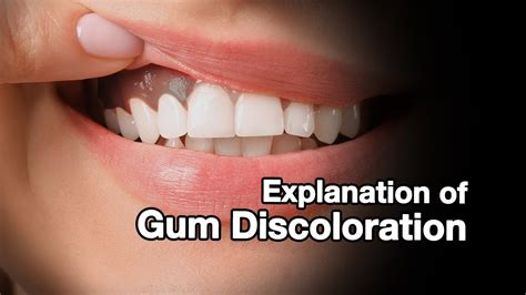 The Hidden Messages: Decoding the Symbolism of Discolored Gums
