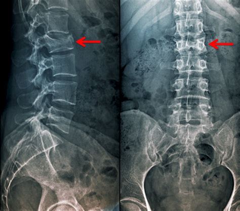 The Impact of Fractured Vertebrae Imageries on Psychological Well-being