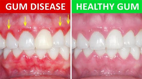 The Impact of Neglected Gum Health: How Gum Infections Reflect Mental and Emotional Well-being