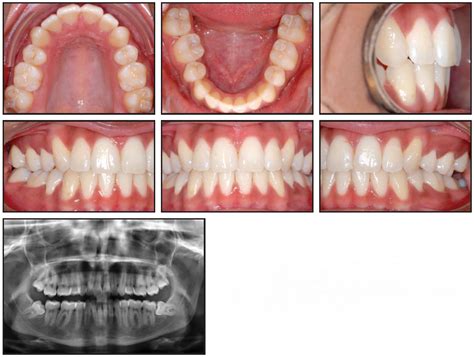 The Impact of Third Molars on Dental Alignment