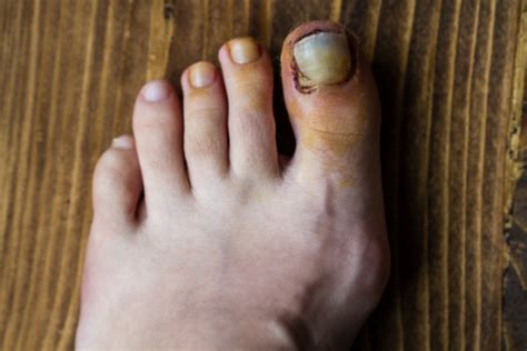 The Importance of Dreams Involving the Loss of a Toe
