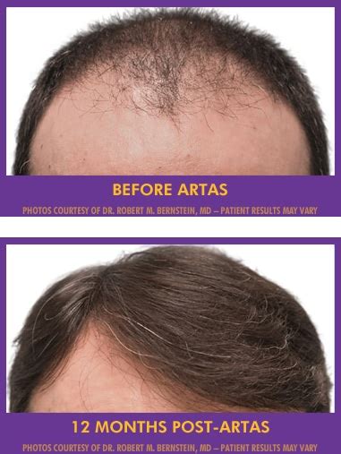 The Increasing Popularity of Hair Restoration Treatments: A Testament to Human Desires
