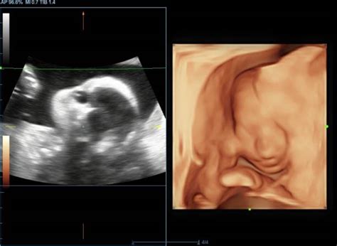 The Influence of Ultrasound Images on Parent-Child Bonding