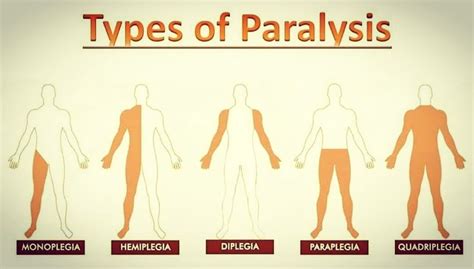 The Paralysis Experience: Decoding the Significance