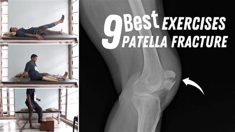 The Physical Aspect: How Dreaming About a Fractured Patella Relates to Your Physical Well-being
