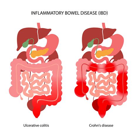 The Risks of Ignoring Unresolved Abdominal Inflammation