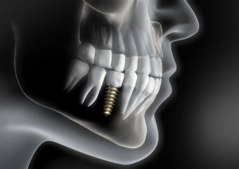The Safety Concerns of Glass Implants: Is It Worth the Risk?