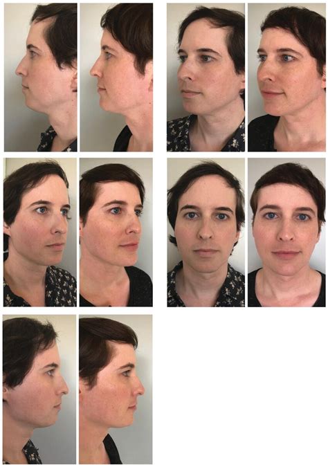 The Science Behind Facial Transformation