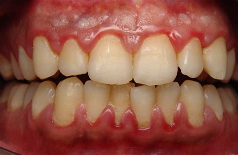 The Shadowed Aspect of Oral Health: Linking Gum Discoloration to Dental Diseases