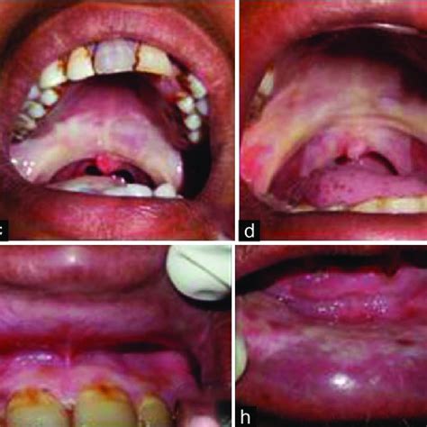 The Significance of Dreams Involving Food Lodged in the Oral Cavity