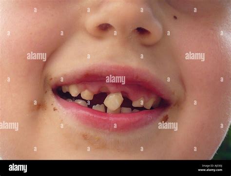 The enigmatic significance of wobbly teeth in visions